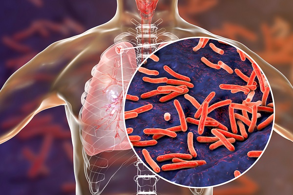 In Ghana it is estimated that up to 40 people die of TB disease daily World TB Day 2022: Noguchi Memorial Institute helps control TB in Ghana